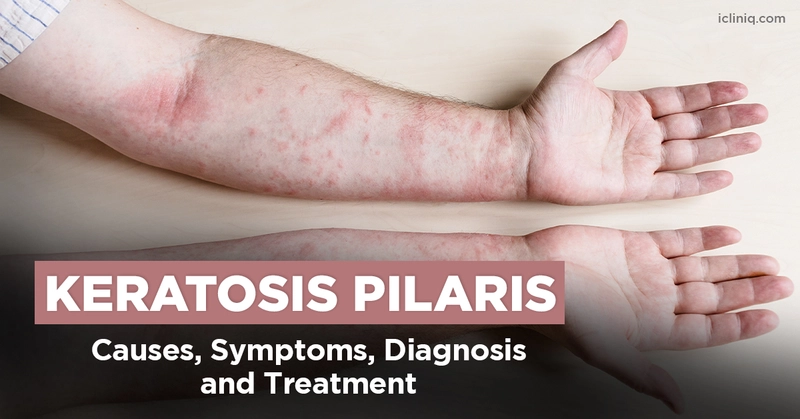 What is Keratosis Pilaris?