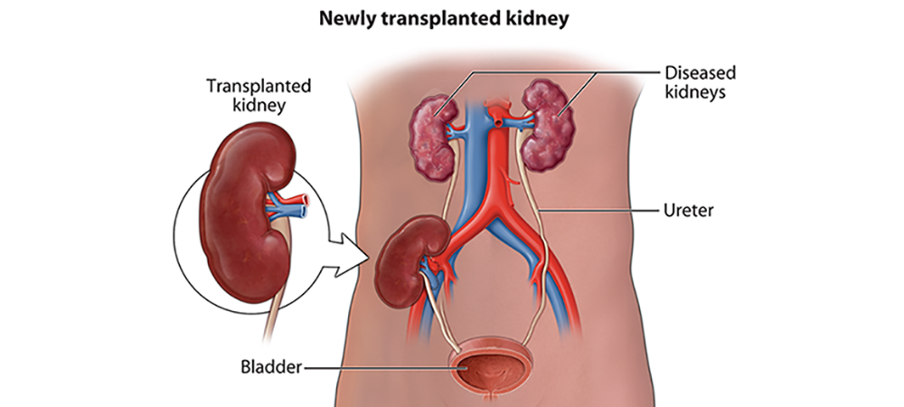 What is Kidney Transplant?