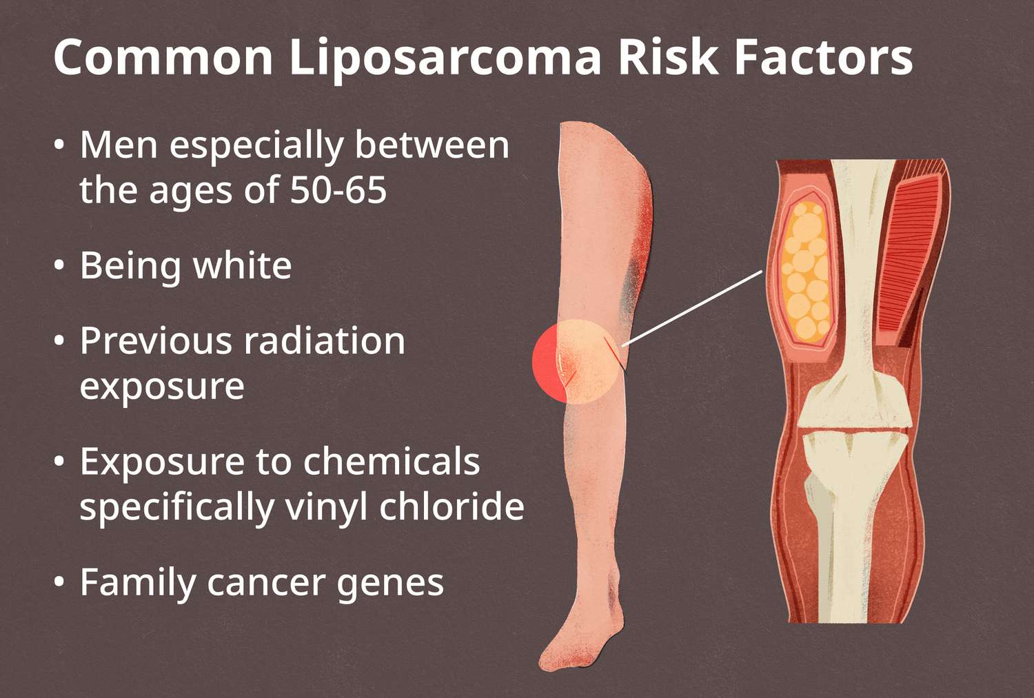 What is Liposarcoma