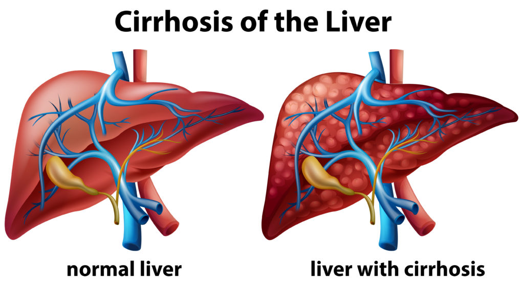 What is Liver Cirrhosis