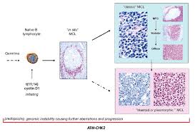 Mantle Cell Lymphoma