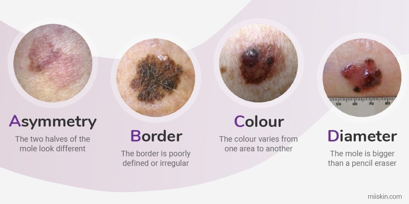 What is Melanoma?