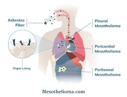 Mesothelioma Cancer