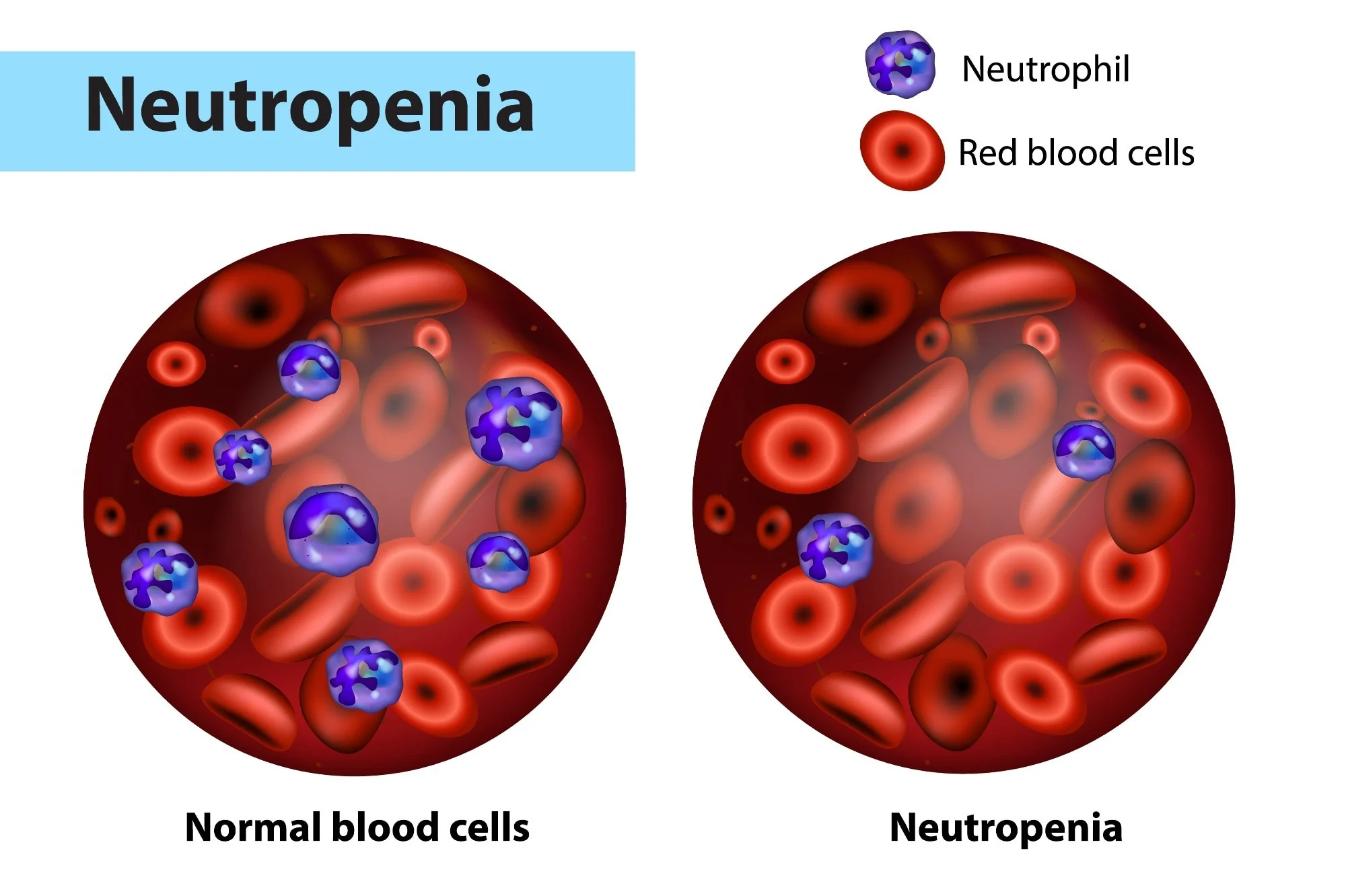 What is Neutropenia?
