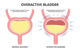 What is Overactive Bladder?