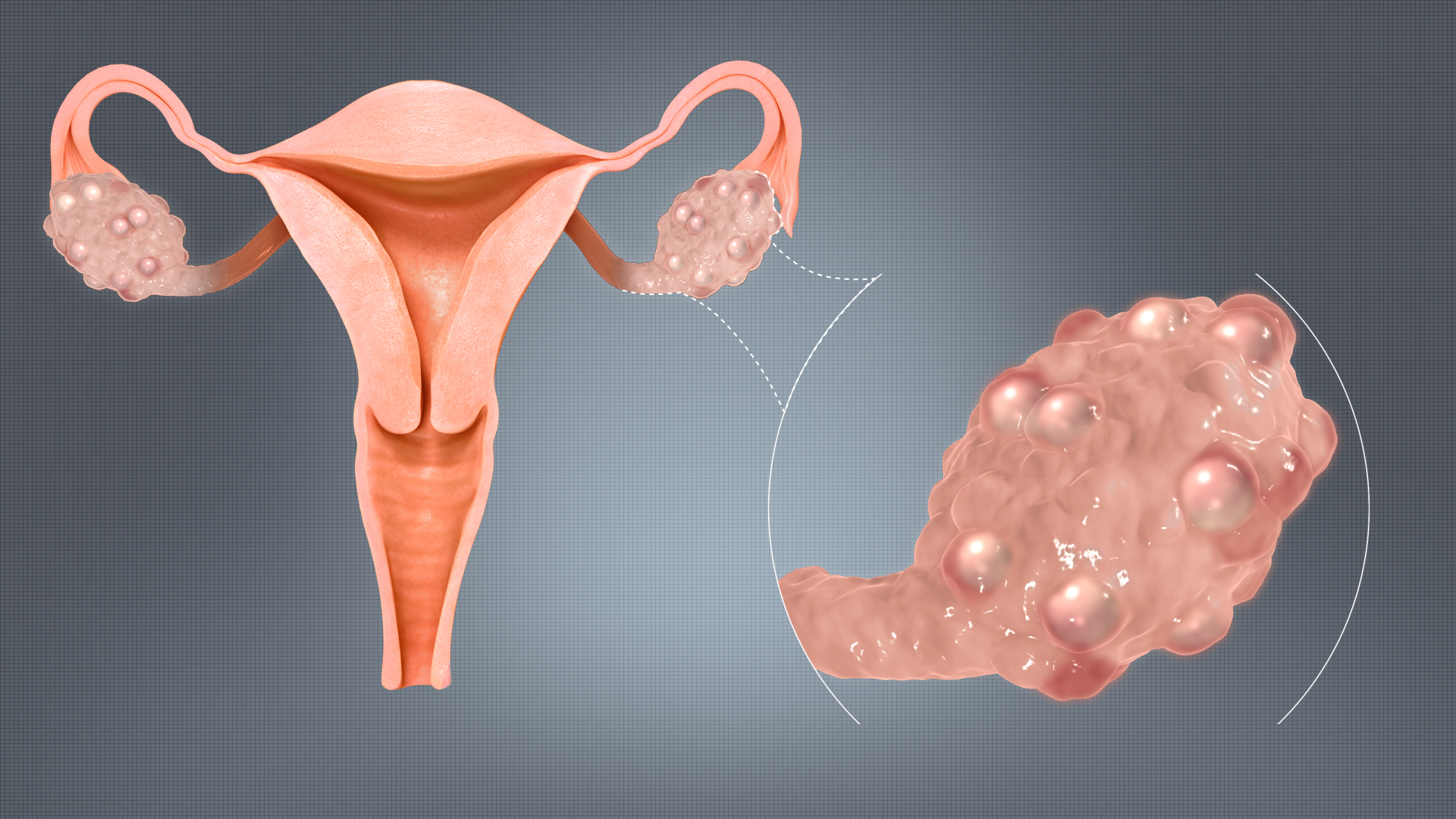 What is Polycystic Ovarian Syndrome?