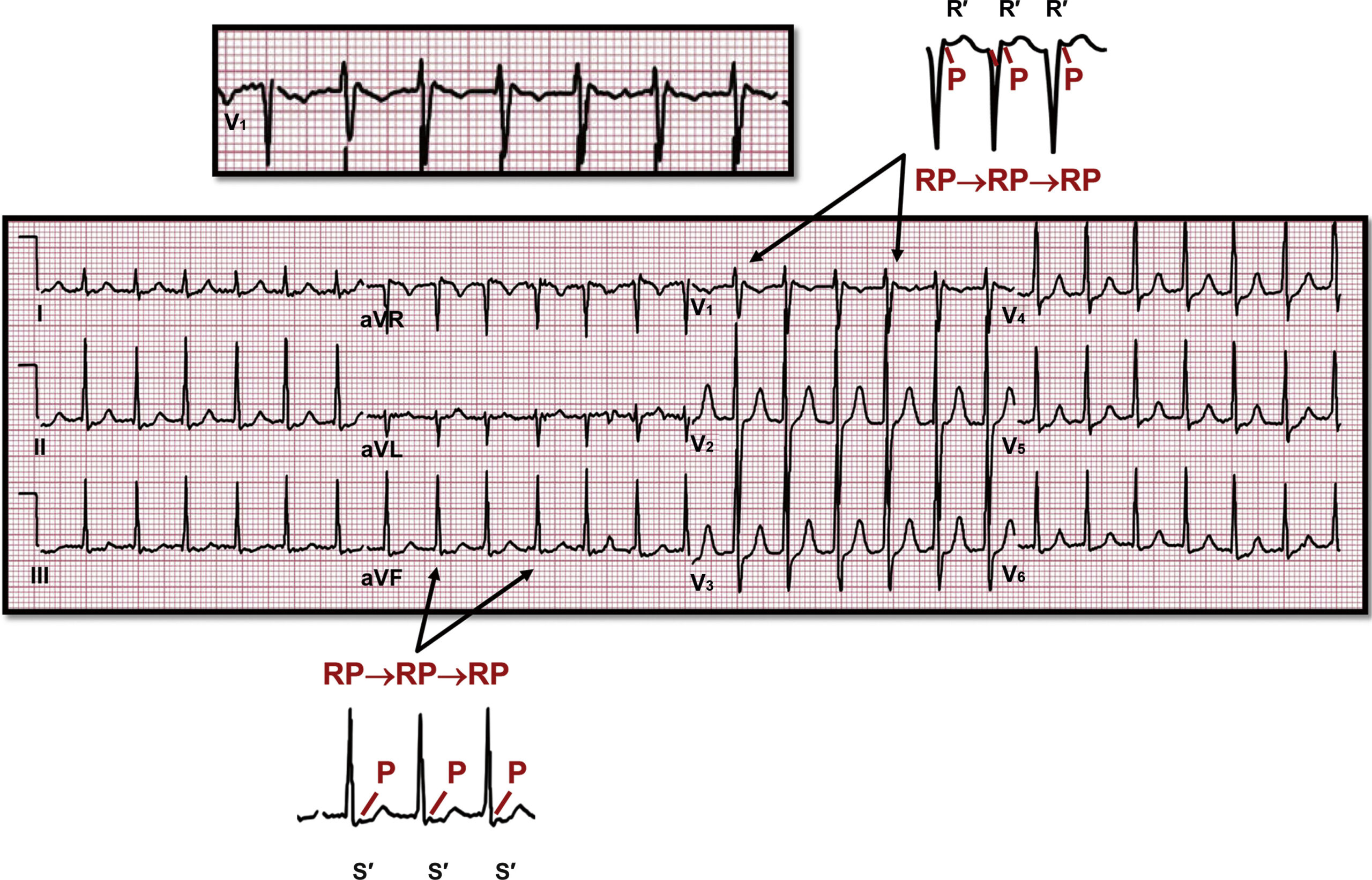 What is Supraventricular Arrhythmias?
