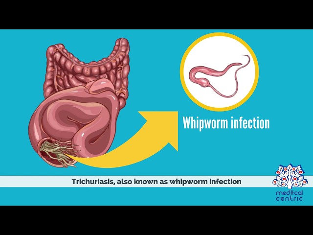 What is Trichuriasis?