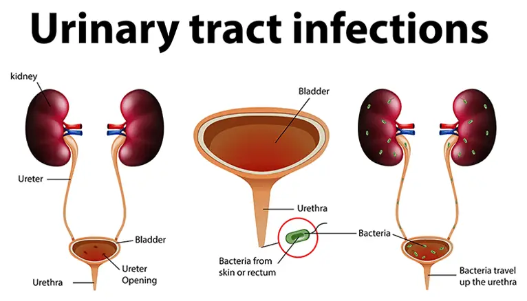 What is Urinary Tract Infections (UTIs)?