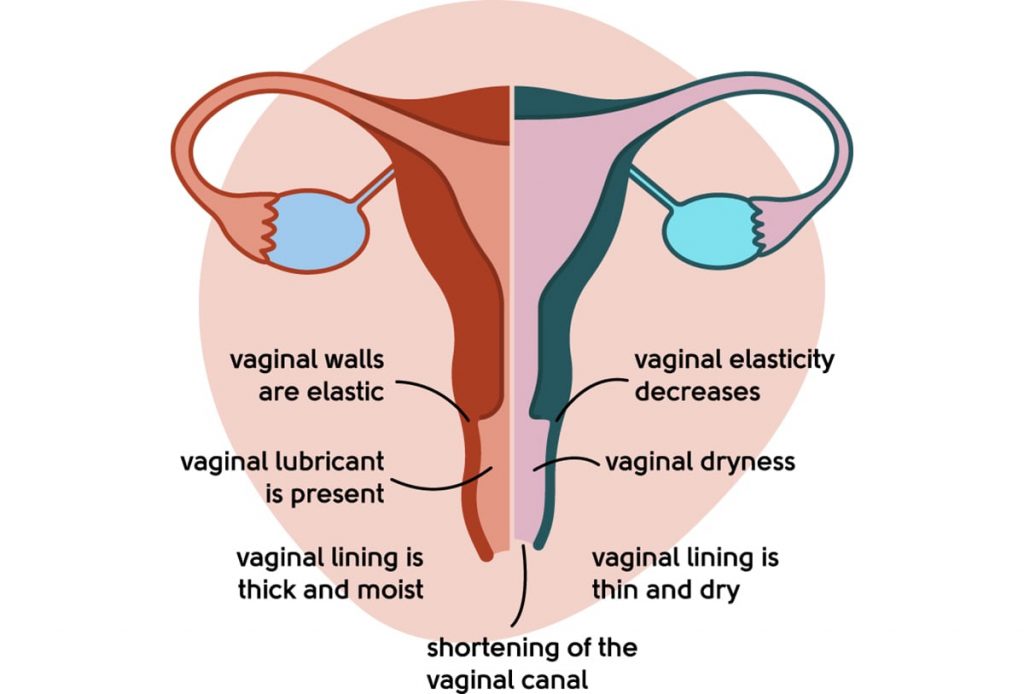 What is Vaginal Dryness?