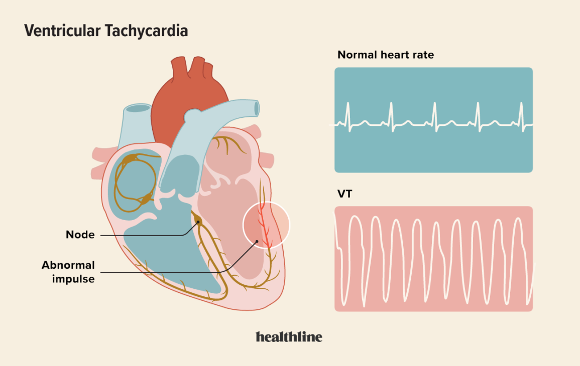 What is Ventricular Tachycardia?