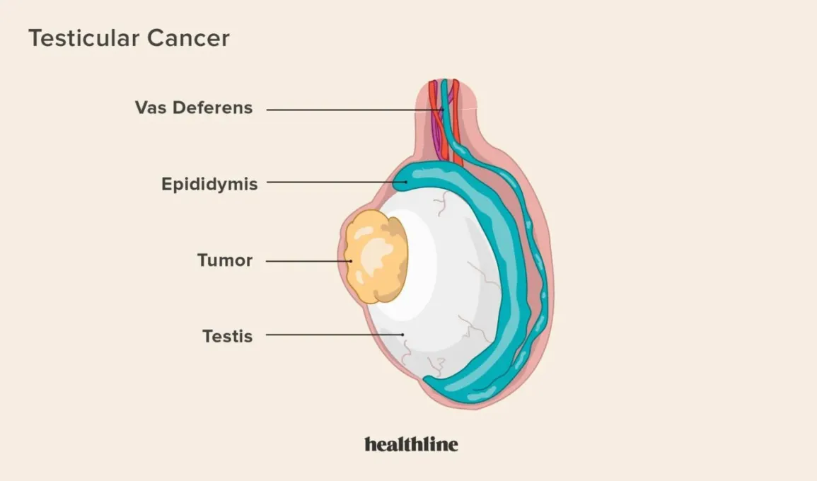 What is Testicular Cancer?