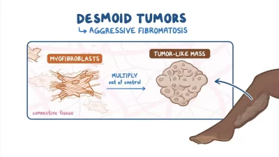 What is a Desmoid Tumor?